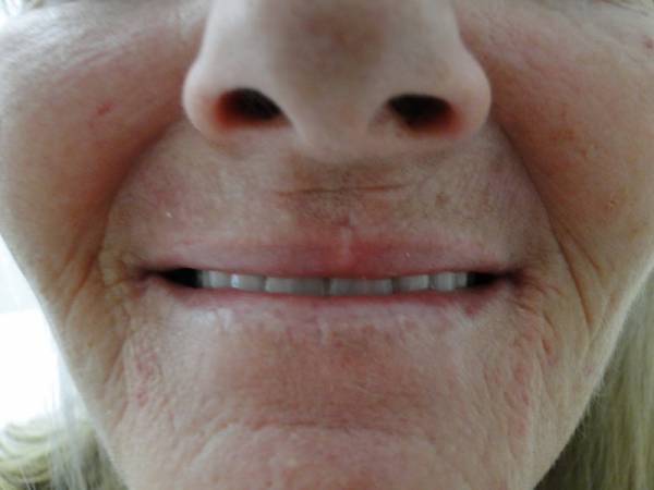 Close-up of the lower half of an older person's face showing their nose, mouth, and teeth, with visible wrinkles and light skin tone.
