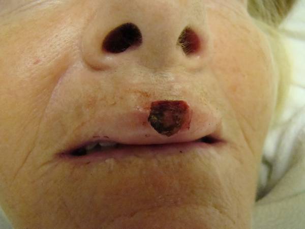 A close-up of an upper lip with a dark, crusted lesion and surrounding redness below the nose on older, light-toned skin.