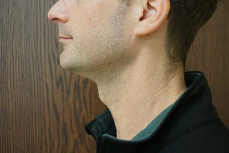 Kybella