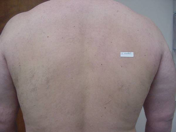 A person's bare back with a small white adhesive label placed on the right shoulder blade area.