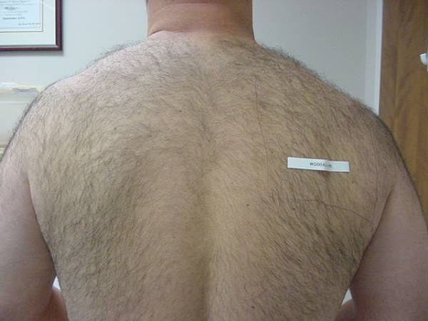 A close-up view of a person's hairy back with a label reading "WOODSLAMP" attached to the right shoulder area.