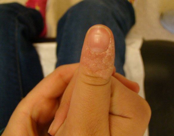 A close-up of a thumb with peeling, dry, and flaky skin near the nail.