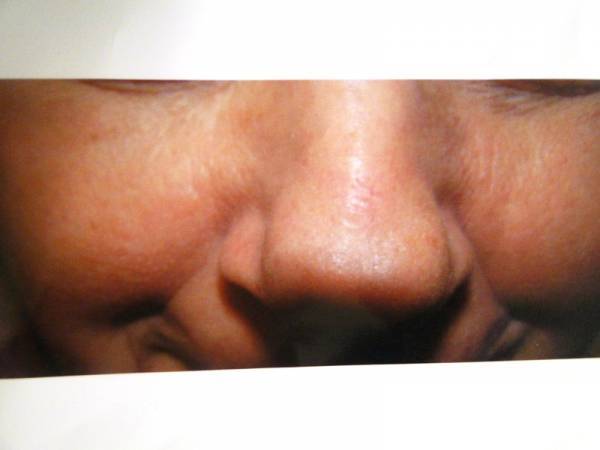Close-up of a person's face, focusing on the nose and cheeks, with slight wrinkles and visible skin texture.