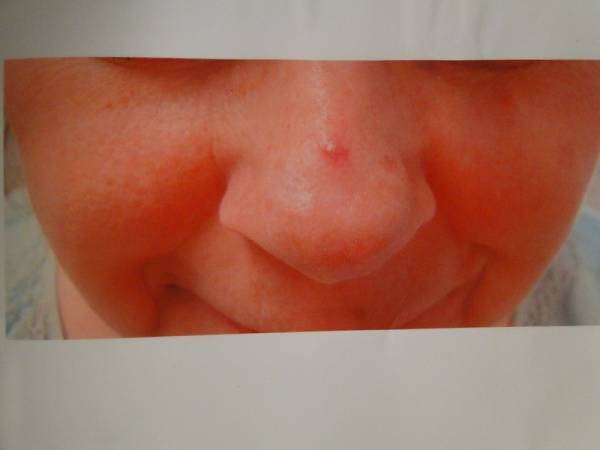 Close-up of a person's nose and cheeks with visible redness and a small pimple on the bridge of the nose.