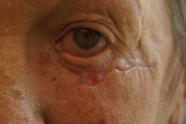 Close-up of a person's face showing an eye and the surrounding skin with visible wrinkles, redness, and a scar below the lower eyelid.