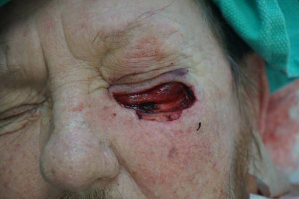 Close-up of a person's face with a severe wound around the left eye, exposing tissue and signs of recent trauma or surgery.