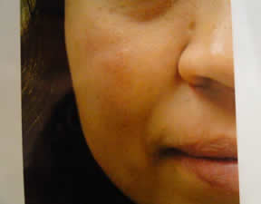 Close-up of the lower half of a person's face, focusing on the cheek and lips, with neutral expression and visible skin texture.