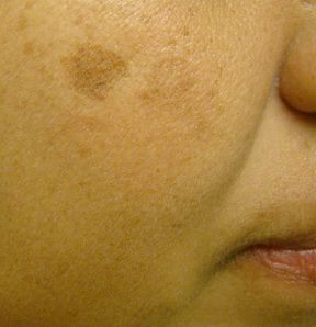 Close-up of a person's cheek showing a noticeable area of hyperpigmentation and some smaller brown spots on the skin.