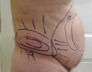 Side view of a person's lower torso and upper thigh with surgical markings drawn in black ink, likely for a medical or cosmetic procedure.