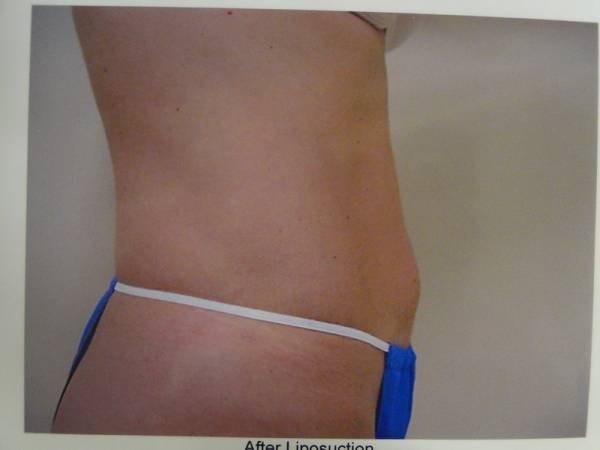 Side view of a person's midsection in underwear, showing a smooth, flat abdomen against a plain background.