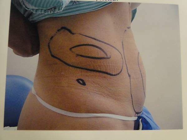 A person’s lower back and side with black surgical markings, possibly preoperative lines for a medical or cosmetic procedure.