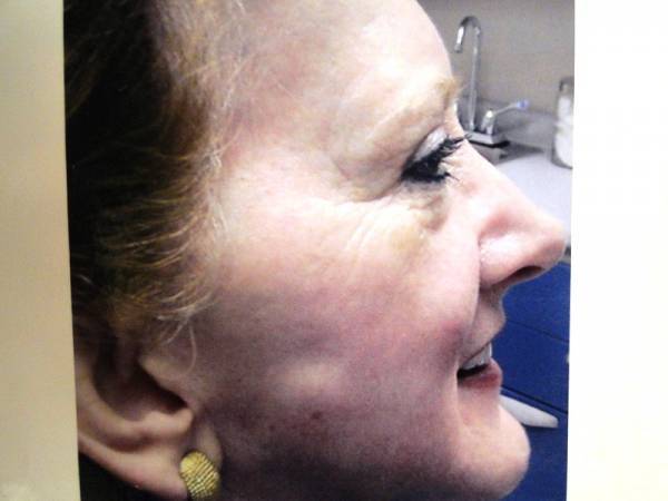 Close-up side profile of an older woman with fair skin, wearing gold earrings, smiling slightly, and sitting in what appears to be a clinical setting.