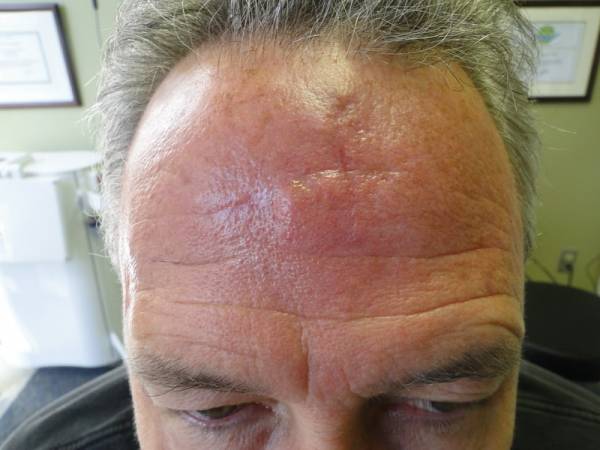 Close-up of a man's forehead showing a prominent horizontal scar and redness on the skin.