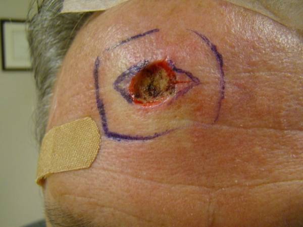 Close-up of a person's forehead with a circular wound marked by purple surgical lines and a bandage below the wound.