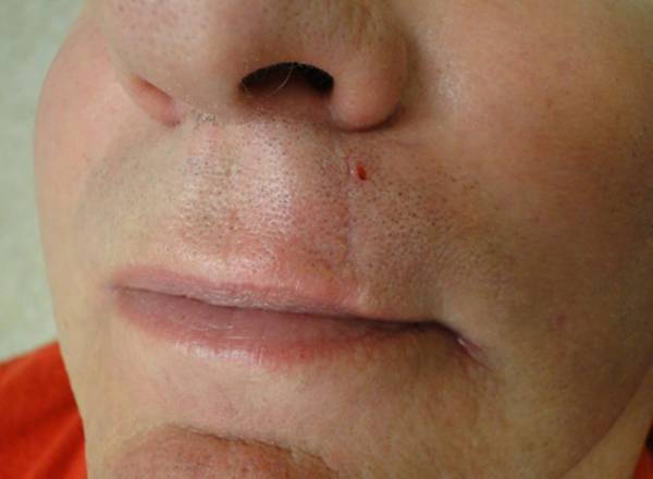 Close-up of the lower face showing a small cut or lesion above the upper lip, slightly to the right of the philtrum.