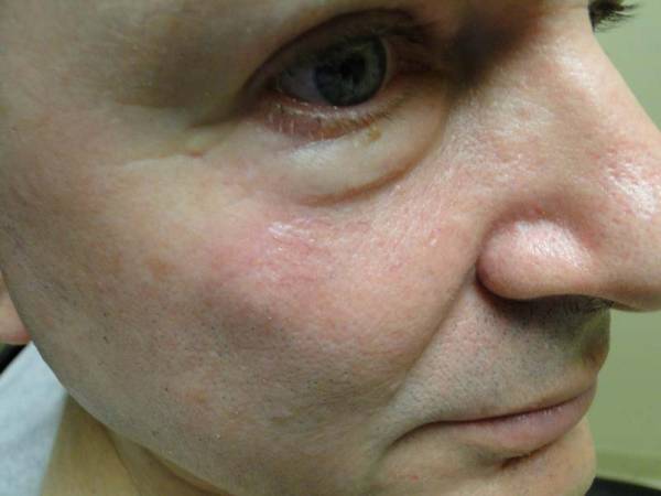 Close-up of the right side of a person's face, showing skin texture, pores, and slight redness on the cheek under the eye.