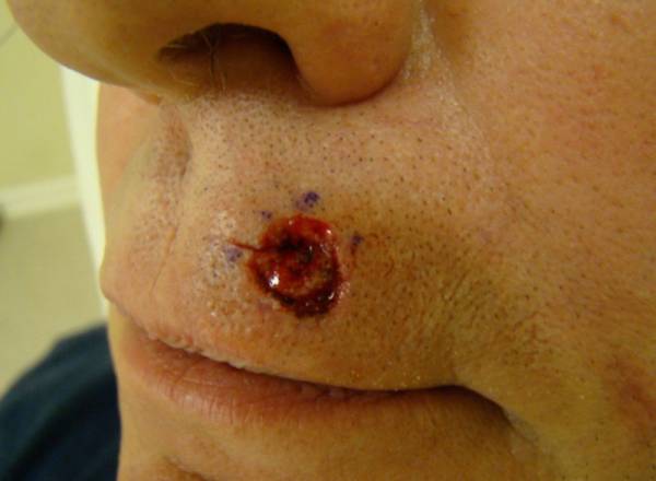 A close-up of a person's face showing a small, circular wound with redness and blood on the upper lip area near the nose.