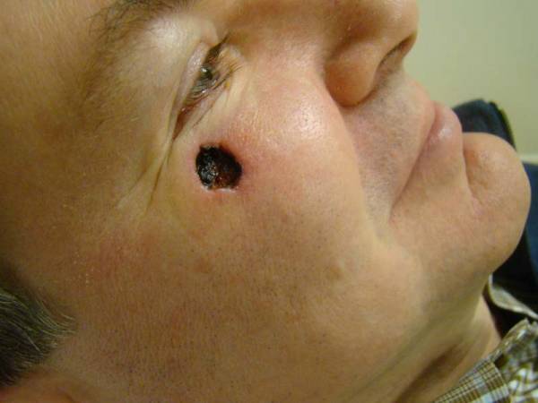 Man lying on his side with a large, dark wound or lesion on his right cheek near his eye.