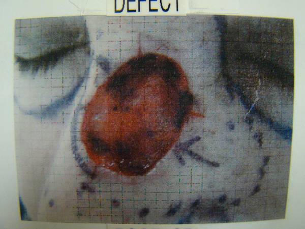 Close-up photo of a skin lesion or wound on a person's face, with the word "DEFECT" labeled above the image.