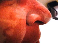 Close-up of a person's face showing a red, irritated rash with distinct lighter and darker patches near the nose and cheek.