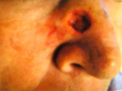 Close-up of a person's nose with a visible wound or ulcer on the nostril area, showing redness and broken skin.