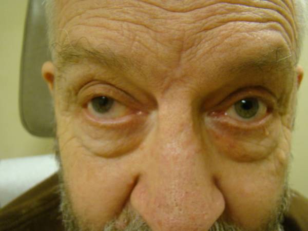 Close-up of an older man's face showing significant drooping of the left upper eyelid, a condition known as ptosis.
