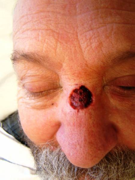 Close-up of a man’s face with eyes closed, showing a round, red, scabbed wound on the bridge of his nose.