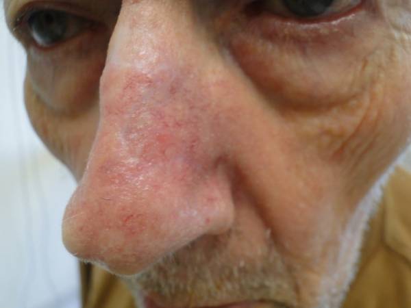 Close-up of an elderly person's face showing redness and visible veins on the nose and surrounding skin.