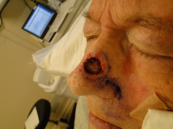 Close-up of a person's face with a circular wound on the nose, showing bruising and swelling, in a medical setting.