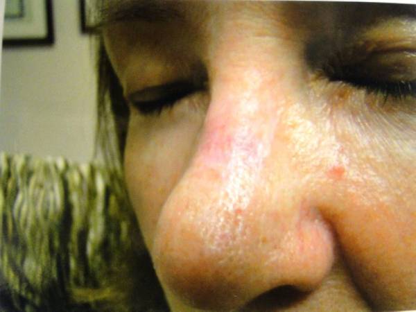 Close-up of a person’s face with eyes closed, showing a shiny, slightly red area on the bridge of the nose and a small blemish on the right cheek.