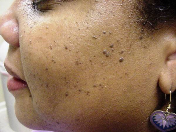 Close-up of a person's cheek and jawline showing multiple small, raised, dark skin growths known as dermatosis papulosa nigra.