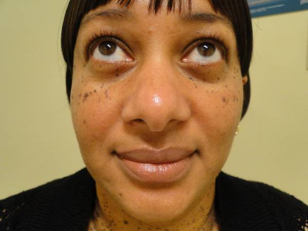 A person with dark spots and freckles on their cheeks, nose, and chin looks upwards, wearing a black top and short, dark hair.