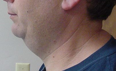 A close-up side view of a person's neck and jawline, showing a double chin. The person is wearing a dark blue shirt.