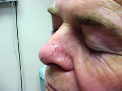 Close-up of a person's face showing a raised, shiny, pinkish lesion on the side of the nose.