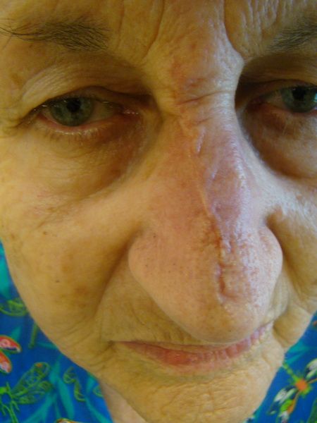 Close-up of an elderly person's face with a prominent vertical scar running down the nose.
