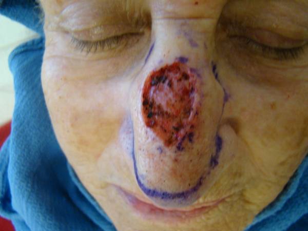 Close-up of a person's face showing a large, open wound with surrounding bruising on the bridge of the nose, outlined with purple surgical marker.