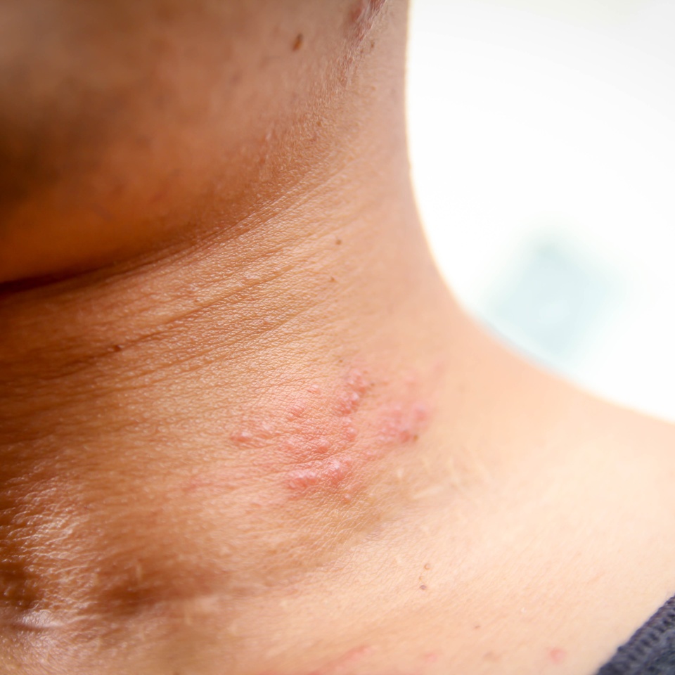 Skin ulcers caused by shingles disease.