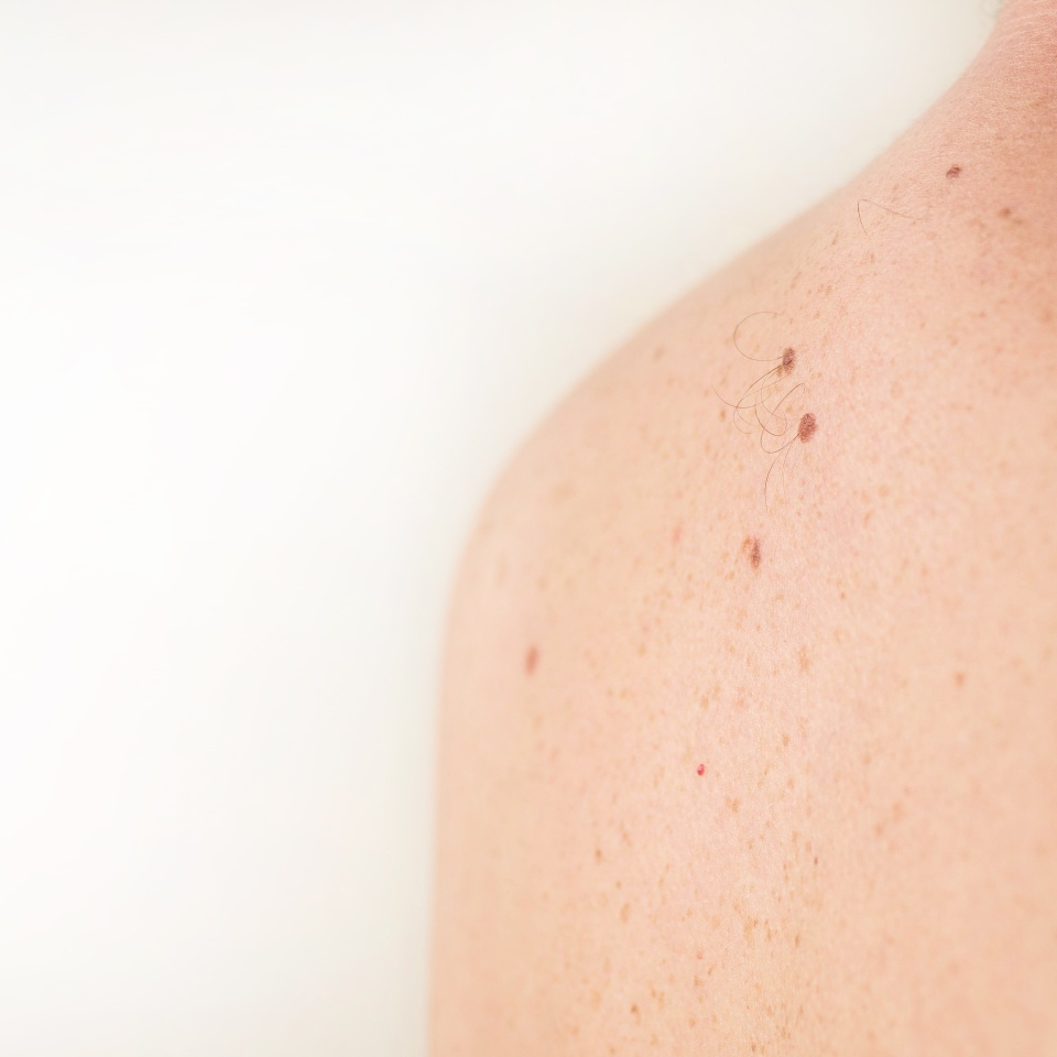 Close up detail of the bare skin on a man back with scattered moles and freckles. Checking benign moles. Sun effect on skin. Birthmarks on skin