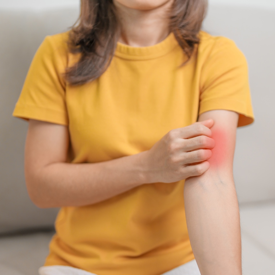 woman itching and scratching itchy arm. Sensitive Skin Allergic reaction to insect bite, food, drug dermatitis. Dermatology, Leprosy day, Systemic lupus erythematosus, Allergy symptoms and rash Eczema