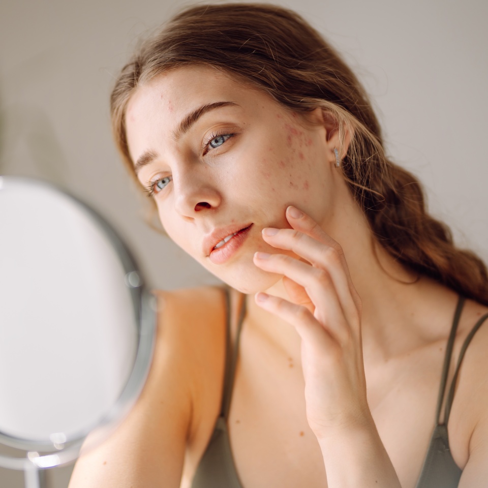 Young woman with problem skin looking into mirror. Concept of acne therapy, scars, inflammation on face, problem skin. Beauty care.