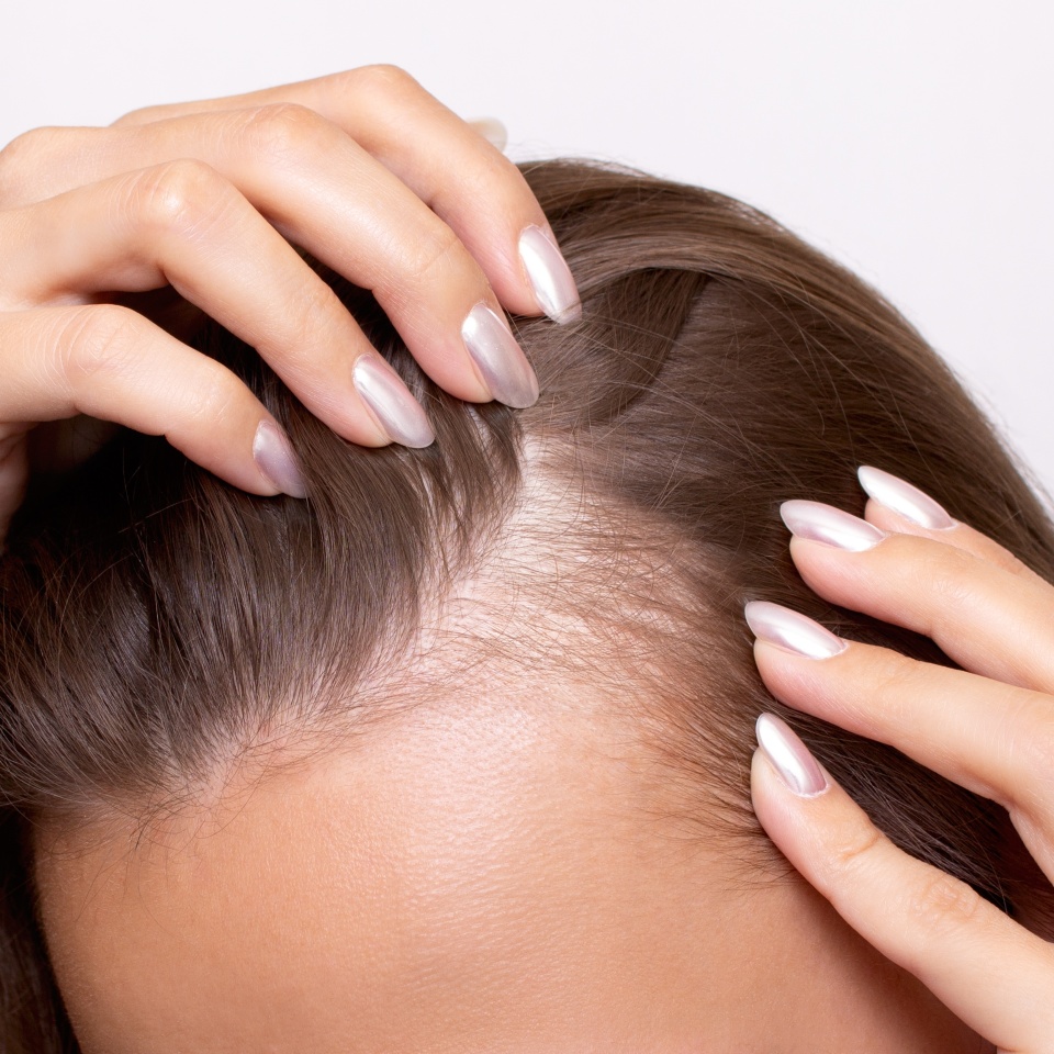 Young woman showing bald spots on forehead and temples with fingers. Baldness. Close-up. Hair care concept and treatment. Hair loss, hair transplant, alopecia