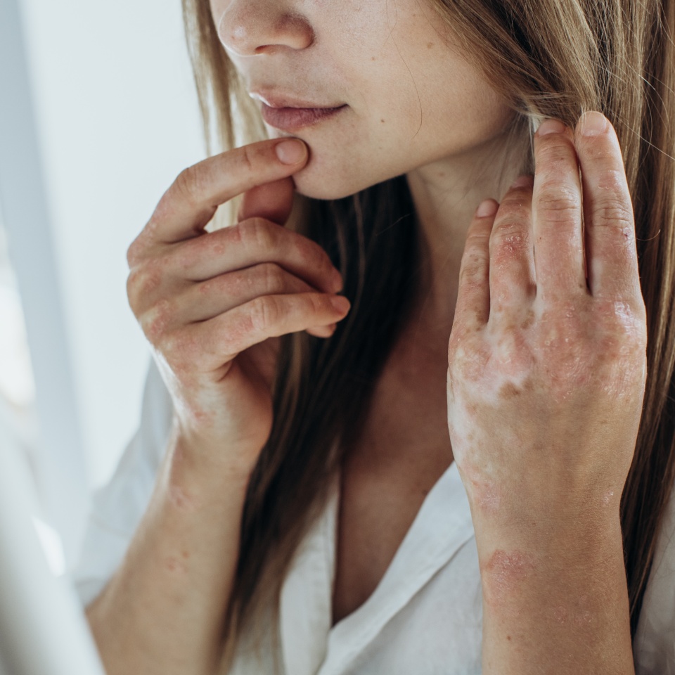 Sick person. Unrecognizable young woman suffering from autoimmune incurable dermatological skin disease called psoriasis. Large red inflamed scaly rash on elbows. joints affected by psoriatic arthriti