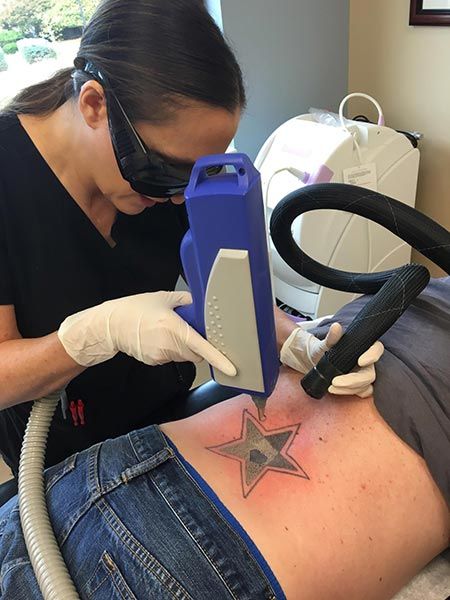 A technician wearing gloves and protective eyewear uses a laser device to remove a star-shaped tattoo from a person’s lower back.