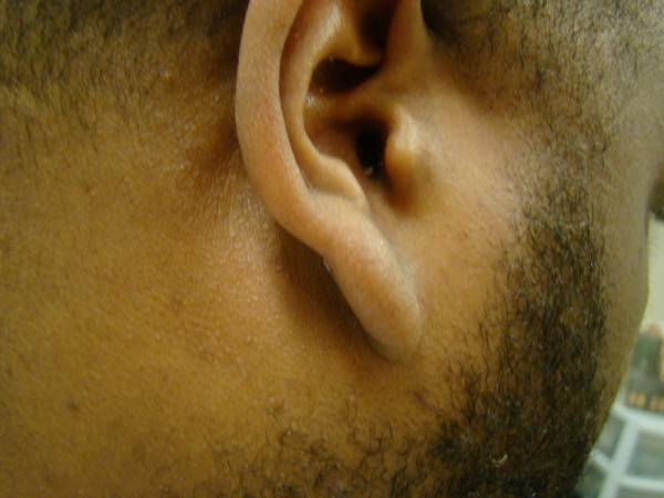 Close-up of the side of a person's face showing an ear with a small lump near the earlobe, surrounded by facial hair.