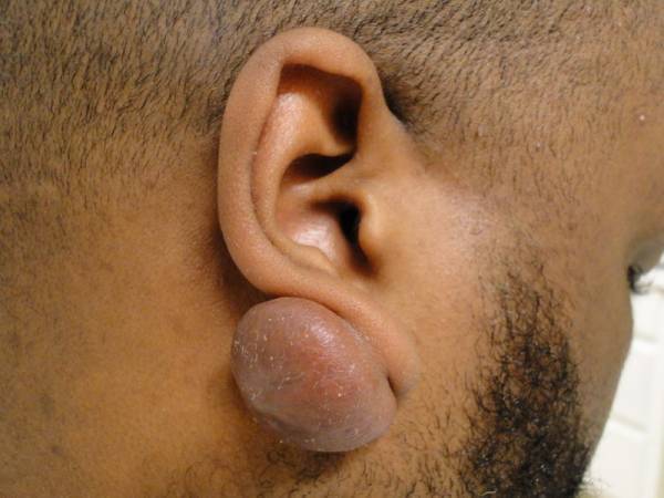 Close-up of a person's ear with a large, raised, rounded growth or lump on the lower earlobe.
