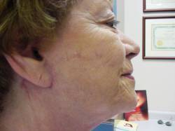 Elderly woman’s face in profile view, showing wrinkles and slight scarring on cheek, with certificates hanging on the wall in the background.