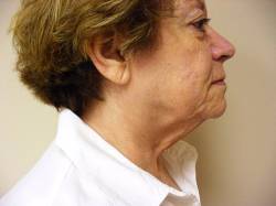 Profile view of an older woman with short hair, wearing a white collared shirt, showing visible signs of aging on her neck and jawline.