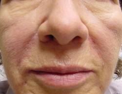 Close-up of the lower face of an older adult showing visible wrinkles and lines around the mouth and nose.