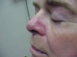 Close-up of a person's face with eyes closed, showing redness and swelling on the nose and surrounding cheek area.