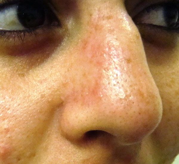 Close-up of a person's face showing visible pores, blackheads, and redness on the nose and surrounding skin.